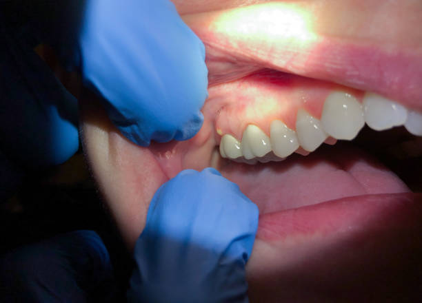 Best Emergency Dental Care for Broken or Chipped Teeth in Ciborne, LA