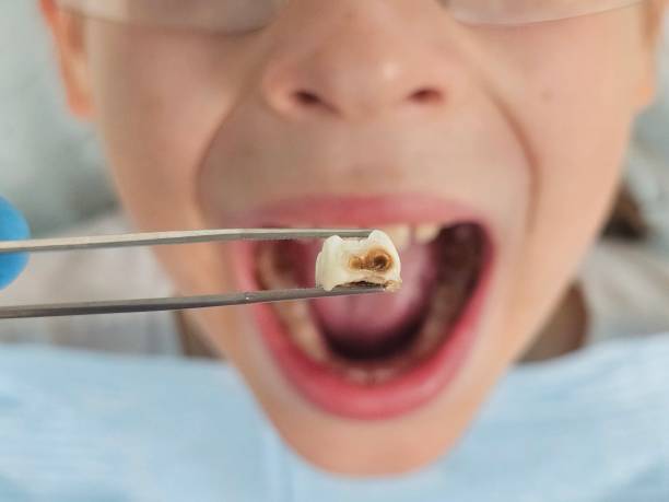 Best Emergency Treatment for Dental Infections or Abscesses in Ciborne, LA