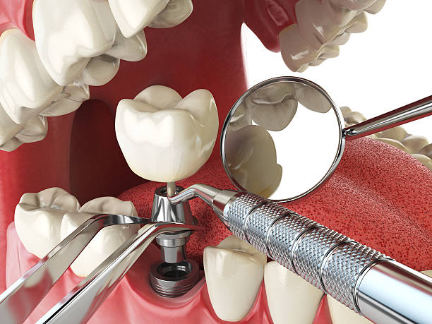 Best Emergency Tooth Extraction in Ciborne, LA